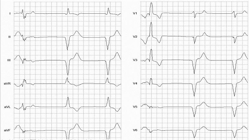 Ventricular Paced Beat LBB Morphology